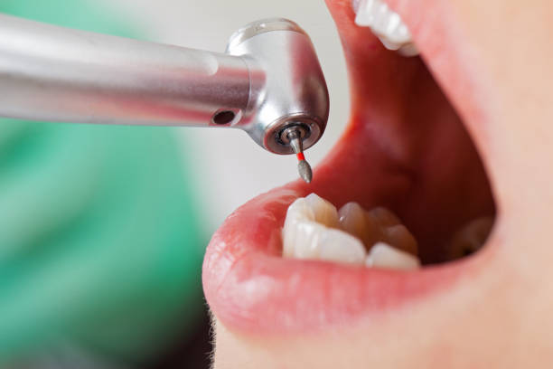 Best Dental Abscess Treatment in Newnan, GA